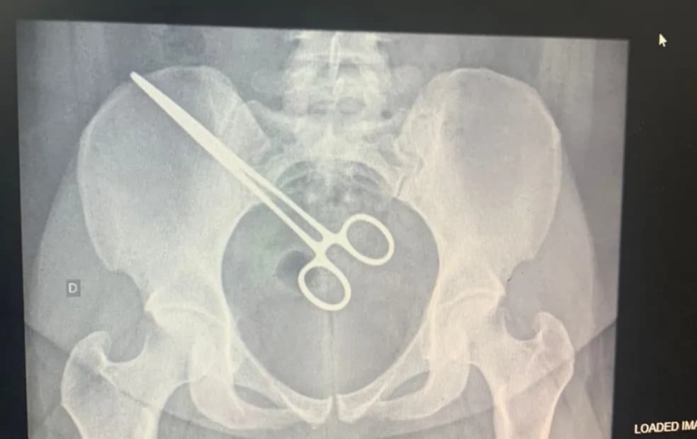 Mulher descobre pinça dentro do corpo ao visitar marido na cadeia em SP