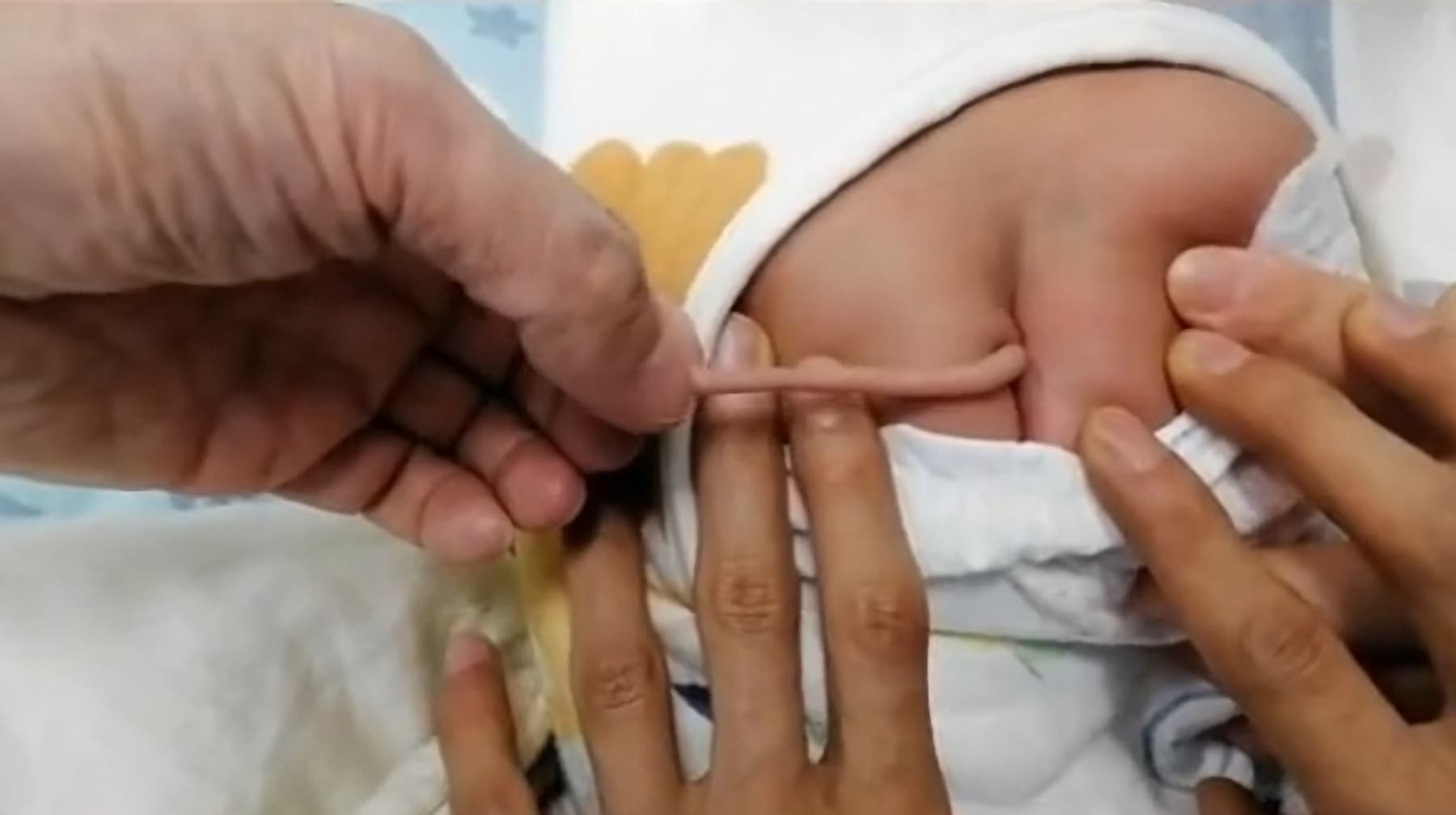 &#8220;Bebê Goku&#8221;? China registra caso de recém-nascido com cauda de 10 centímetros