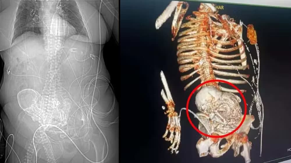 INCRÍVEL: Idosa morre durante retirada de &#8220;bebê de pedra&#8221; que ela carregou por 50 anos
