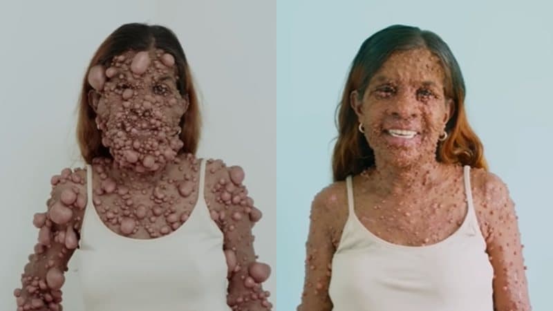 Nos EUA, mulher com doença rara enfrenta cirurgia de 60 horas acordada para remover tumores