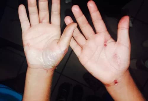 Em Manaus, madrasta é acusada de queimar as mãos e pernas de criança de 1 ano com colher quente