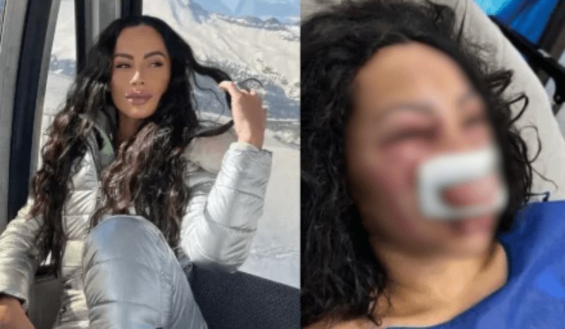 Brasileira é internada em estado grave após ser espancada durante assalto no Chile