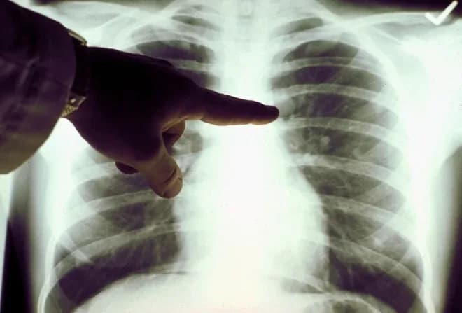 Casos de câncer de pulmão em não fumantes aumentam; saiba como se prevenir