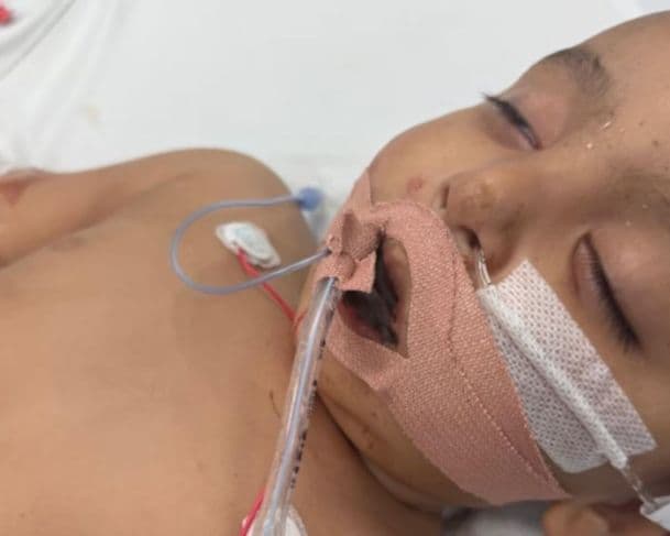 Bebê de um ano ingere soda cáustica e sofre queimaduras internas