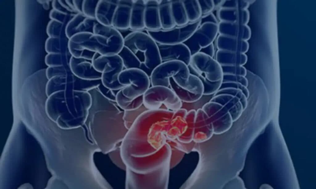 Câncer colorretal: Maioria dos pacientes é diagnosticado em estado avançado, diz estudo