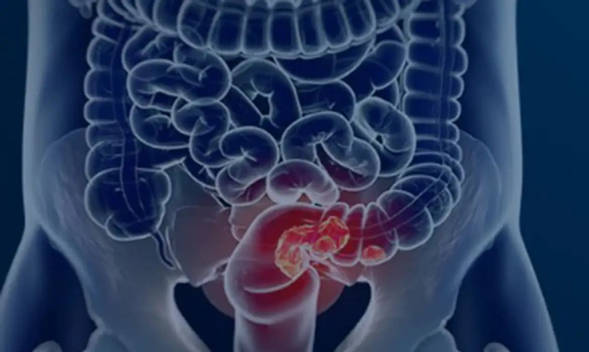 Câncer colorretal: Maioria dos pacientes é diagnosticado em estado avançado, diz estudo