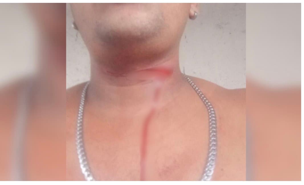 Jovem quase é degolado por linha de cerol em Manaus