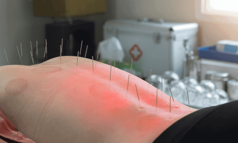 Acupuntura passa a ser profissão regulamentada por lei em todo o Brasil