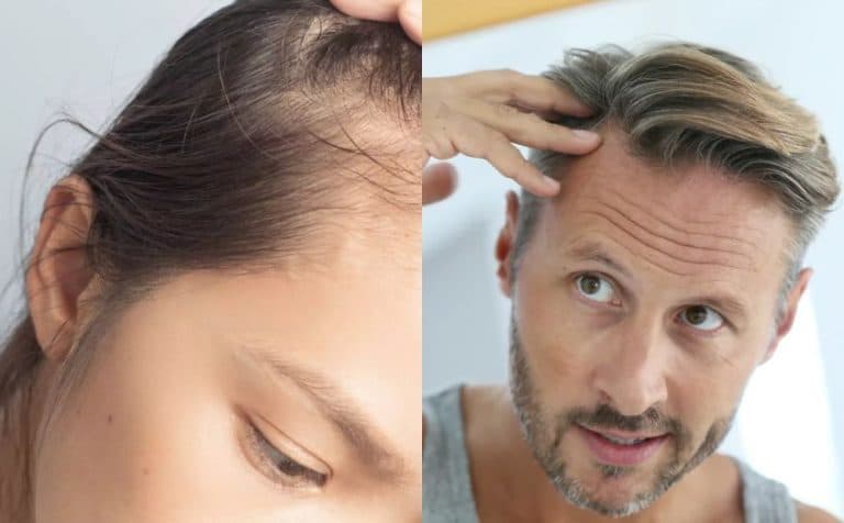 Cresce procura por transplante capilar no Brasil com público mais jovem e diversificação de procedimentos