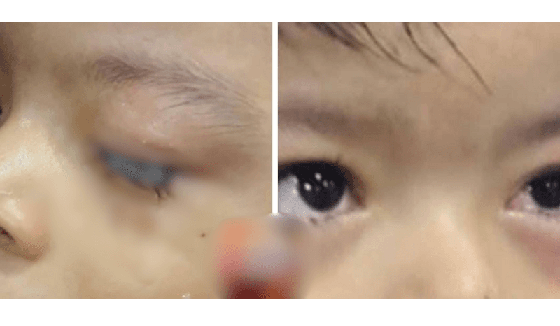 Criança de 2 anos cola próprios olhos e deixa família desesperada em Parintins