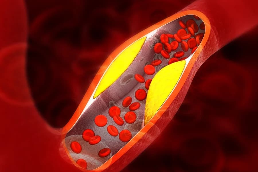 Gordura no coração: cardiologista explica os principais sintomas de doença silenciosa