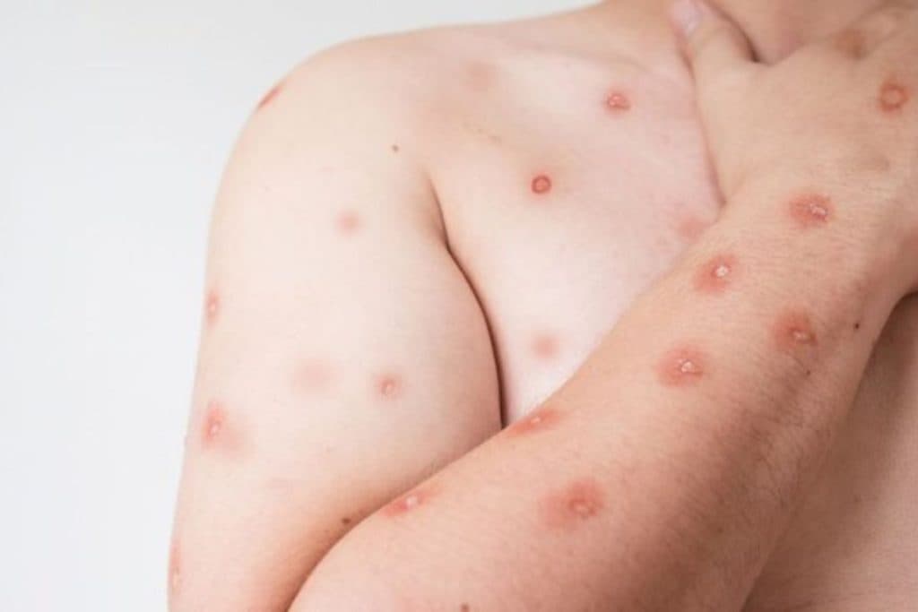 Mpox: saiba diferenciar mitos e verdades sobre a doença