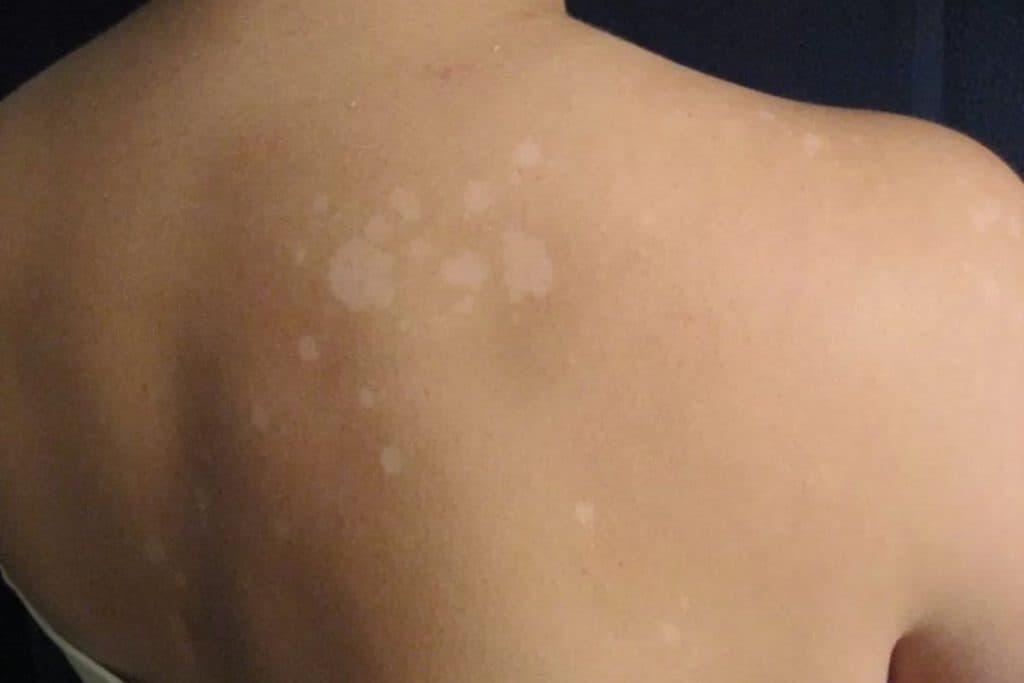 Pano branco, saiba como identificar e qual o tratamento ideal