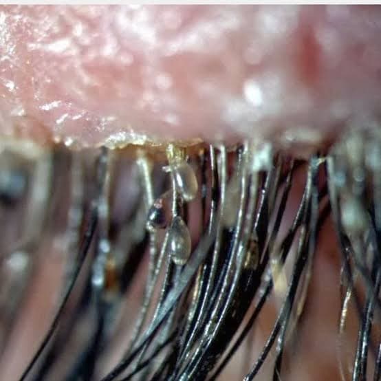 Piolhos nos cílios? Infestação rara pode causar coceira e irritação nos olhos