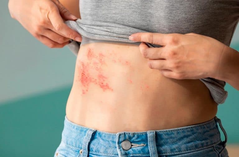Herpes-zóster: Especialista fala sobre doença que afeta a pele e pode atingir os nervos