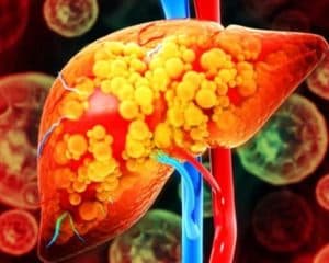 Novo remédio reduz gordura no fígado e mostra resultados promissores contra obesidade