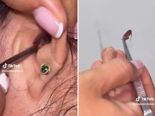 VÍDEO: Médica remove barata do ouvido de paciente, na Colômbia