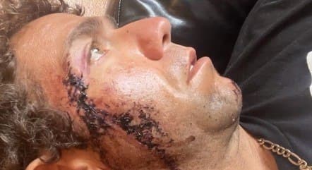 Em praia, sufista é mordido por tubarão no rosto e leva 18 pontos