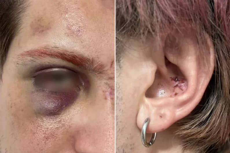 Homofobia: Casal gay é espancado no litoral de São Paulo