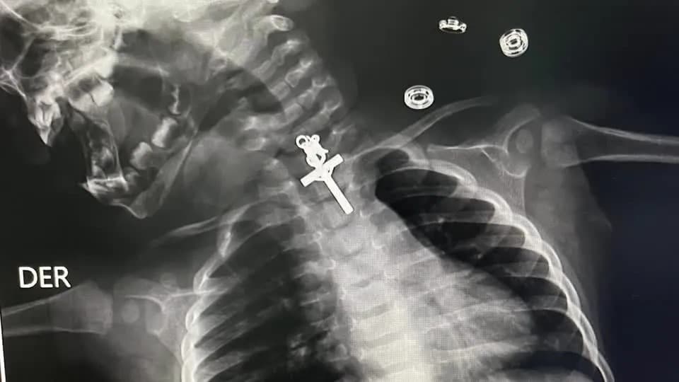 Bebê de 10 meses é operado no Peru após engolir crucifixo