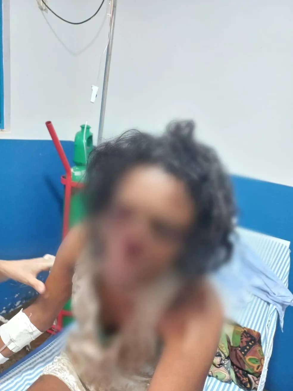 Mulher tem nariz arrancado com mordida durante briga com marido