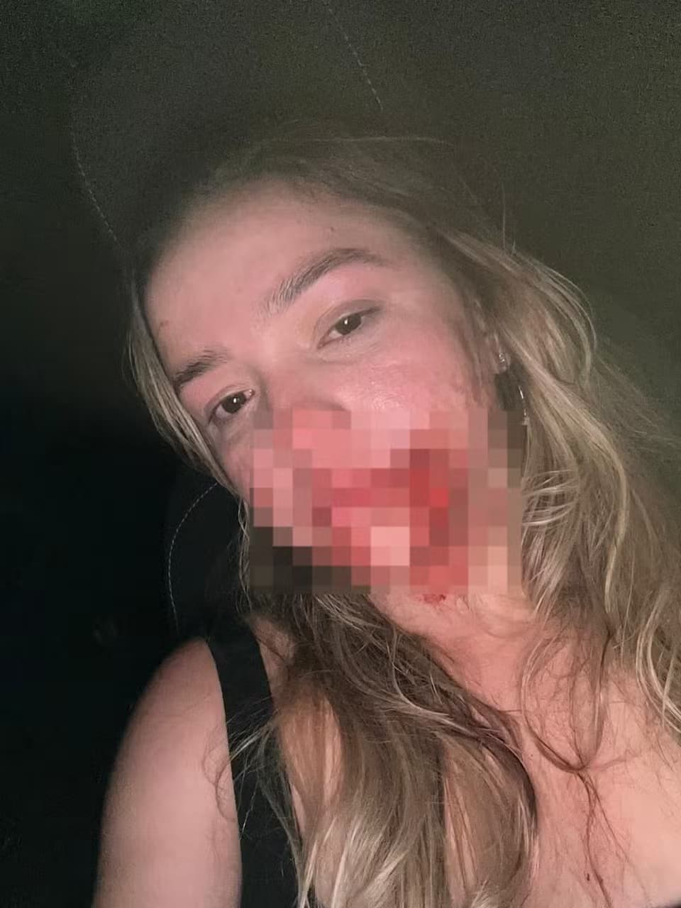 VIDEO: “Cortou de um lado a outro do meu rosto”, diz modelo que acusa síndico de agressão em Teresina