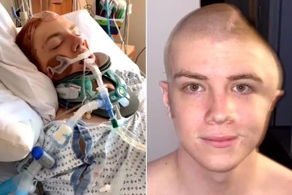 Rapaz contrai infecção e tem o crânio removido para lavagem