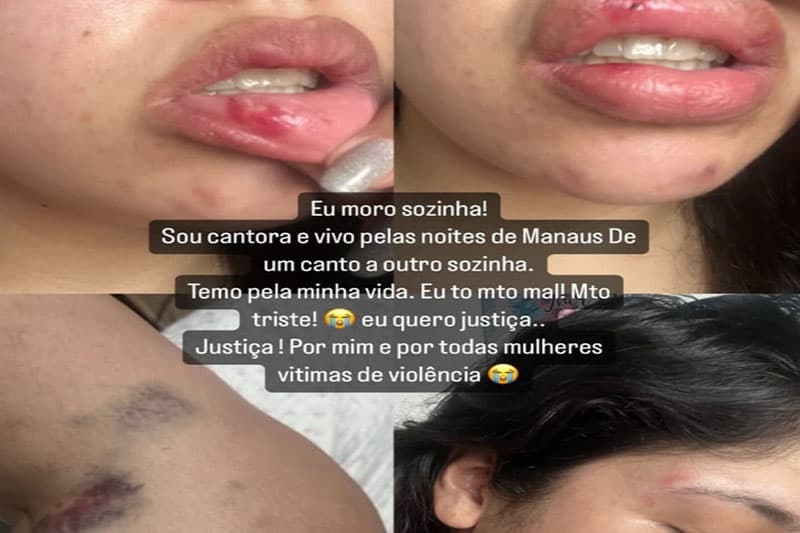 Cantora exibe marcas de agressões de namorado, lutador de MMA