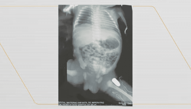 Grávida é atingida por tiro durante assalto e bala fica alojada na perna do bebê, no Maranhão