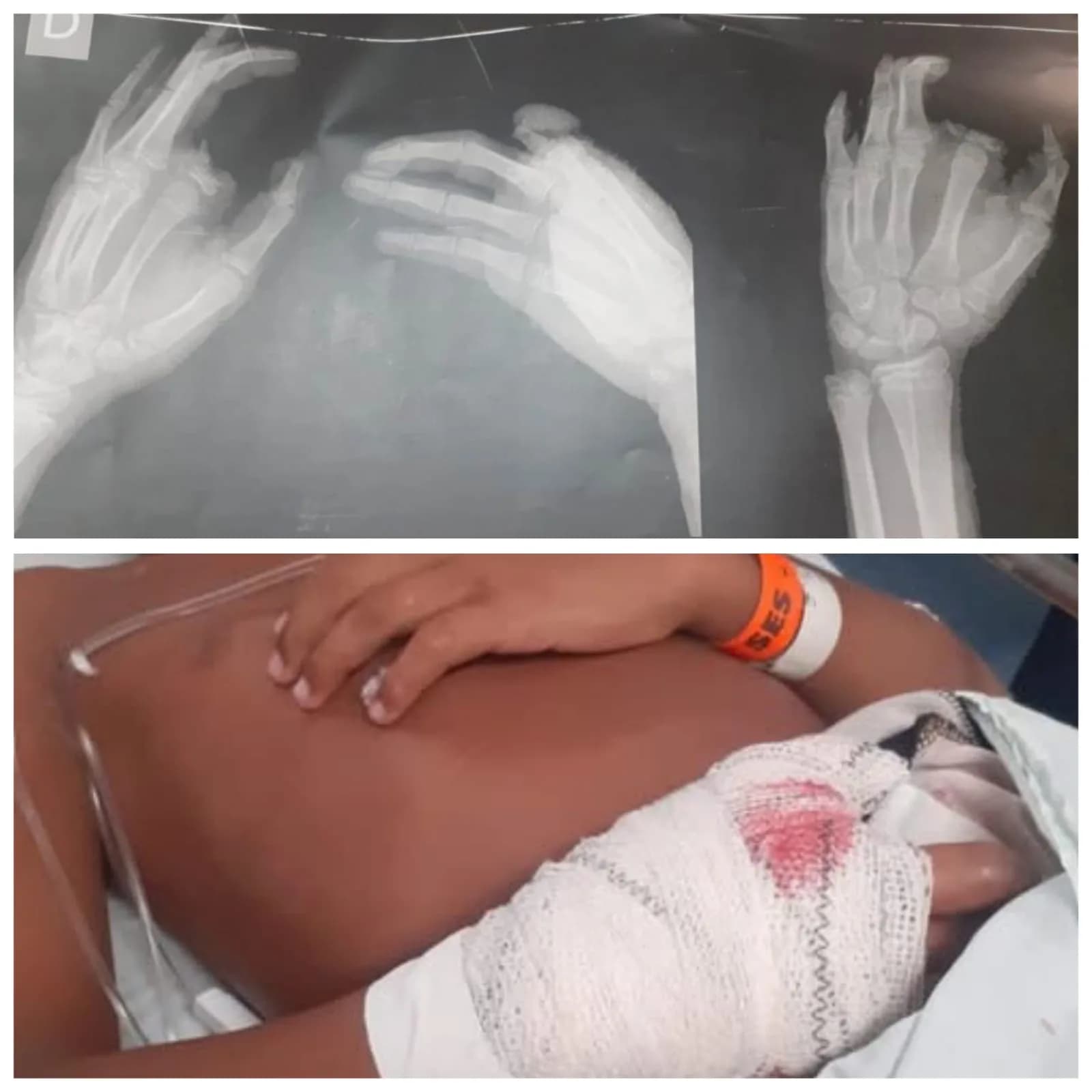 VÍDEO: aluno de escolinha de futsal perde dedo após achar bomba na entrada do clube em Recife