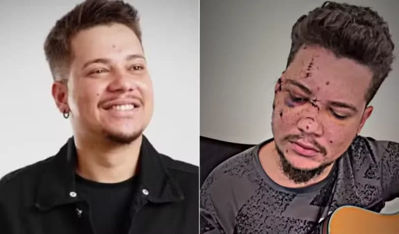 MG: Cantor sertanejo leva 32 pontos no rosto após ser agredido em Show