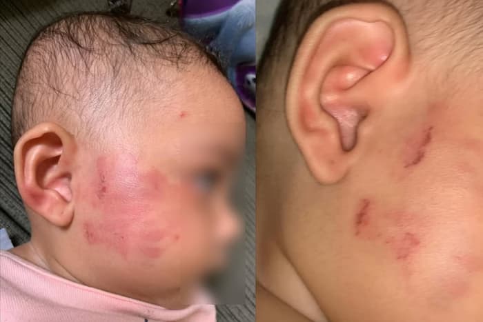 VÍDEO: Bebê de 6 meses é mordida em creche de SP, e mãe denuncia nas redes sociais