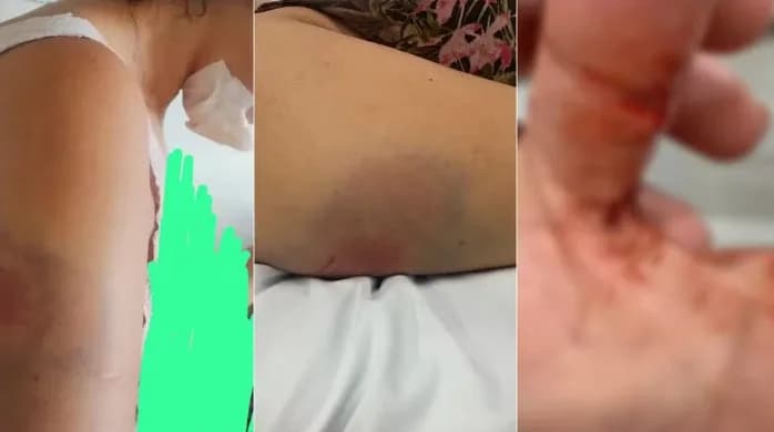 Em Fortaleza, mulher tem queixo destruído e lábios arrancados por marido