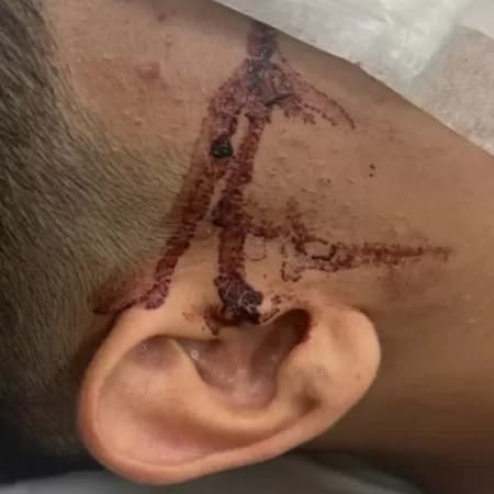 Adolescente de 15 anos fica cego após brincadeira com barra de ferro em escola; entenda