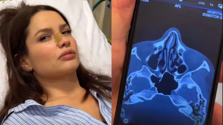 Juliette sofre acidente doméstico e vai parar no hospital: “Acabei de bater a boca e o nariz na janela”