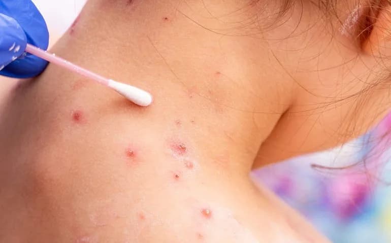 Casos de catapora em escolas de Iranduba são confundidos com Mpox