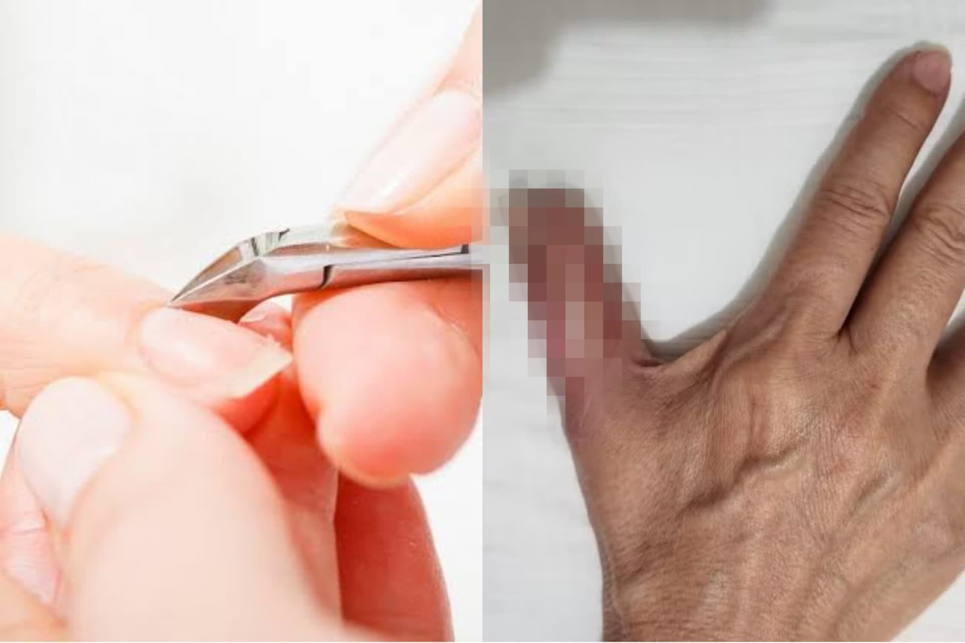 Mulher perde parte do dedo após fazer as unhas em salão de beleza; veja fotos