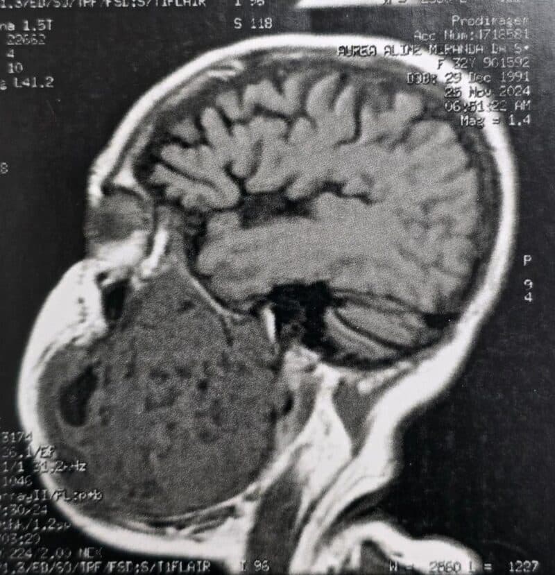 Tumor de mais de 2 kg é retirado de mandíbula de paciente em Manaus