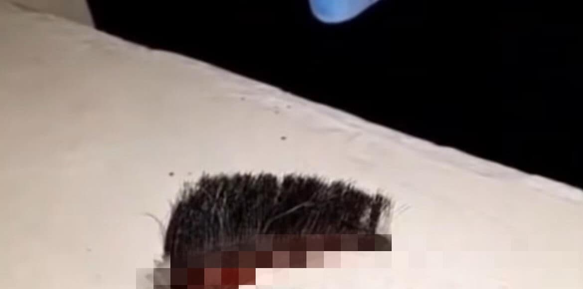 Motociclista que teve couro cabeludo arrancado em acidente morre em Manaus