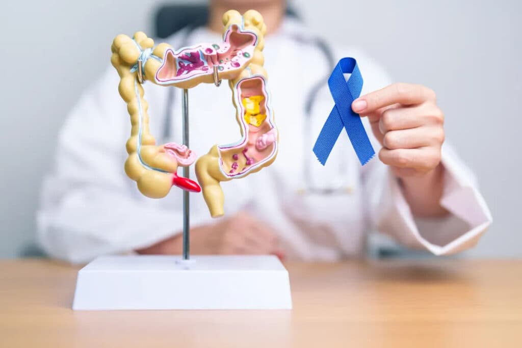 Câncer em menores de 50 anos avança, e o colorretal lidera