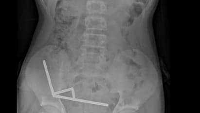 Menino de 13 anos perde parte do intestino após engolir mais de 80 ímãs