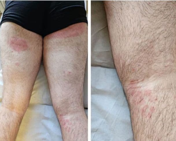 Superfungo que ataca axilas e nádegas avança no Reino Unido e acende alerta; tratamento contra infecção é extremamente tóxico