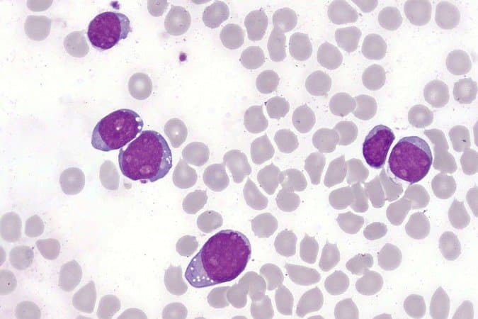 Células modificadas vencem leucemia agressiva e colocam pacientes em remissão histórica