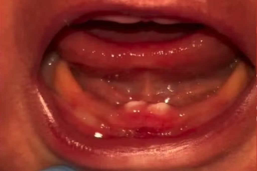 Bebê em Rondônia nasce com dentes e passa por cirurgia