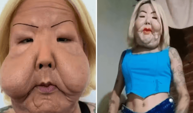 Após cirurgia para retirar óleo do rosto, Juju do Pix mostra evolução 50 dias depois