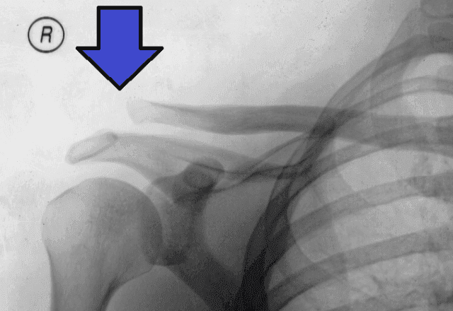 Ondas de choque ganham força na medicina e aceleram recuperação de lesões sem cirurgia