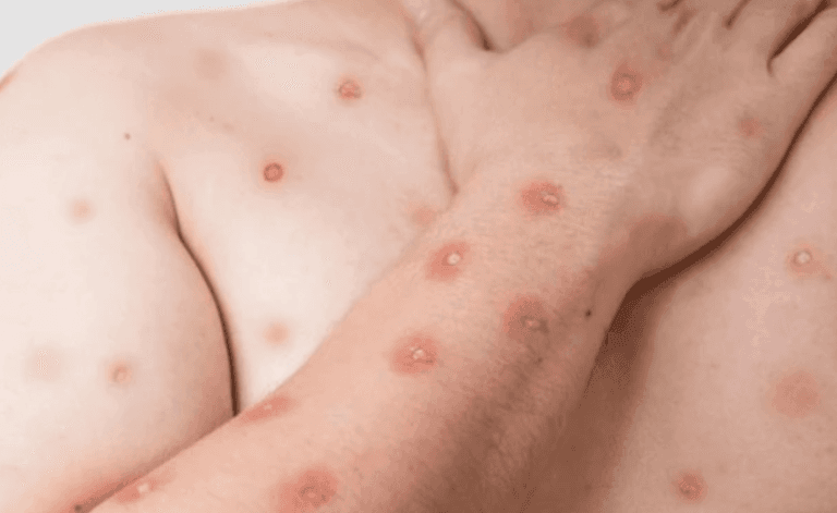 Santos confirma dois casos de Mpox