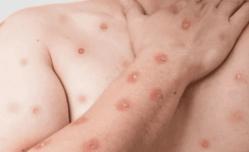 Santos confirma dois casos de Mpox