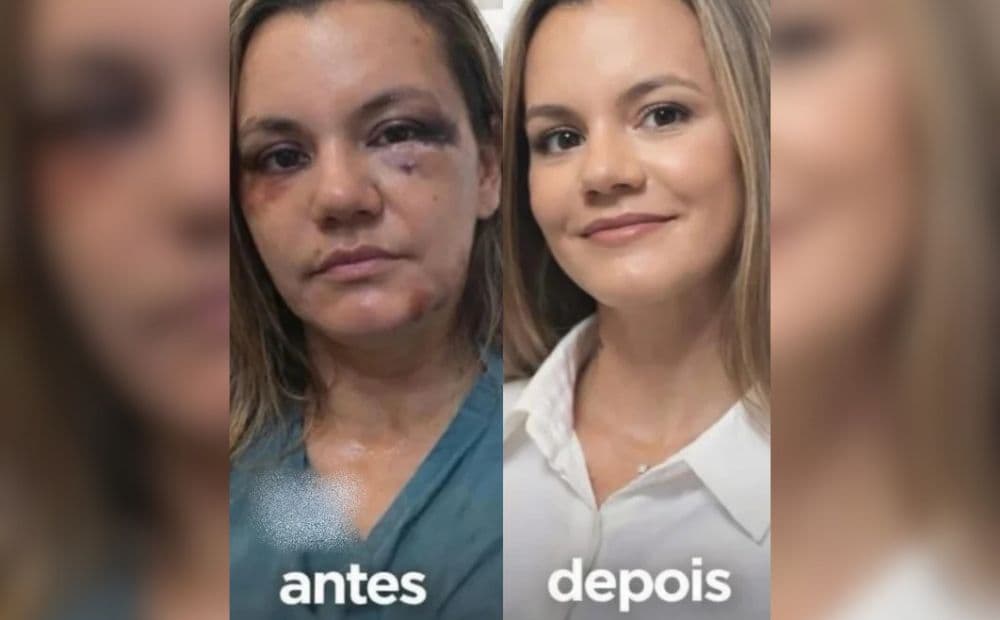 Mulher agredida com 60 socos mostra resultado de cirurgias no rosto