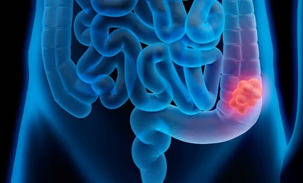 Câncer colorretal é o terceiro mais incidente entre amazonenses, segundo FCeco